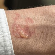 Galaxy Watch, alcuni utenti segnalano delle presunte ustioni al polso